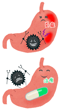 ピロリ菌